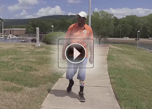 Fourroux-Prosthetics-HSV-Eugene_500x357_thumb